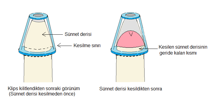 klips-uygulanis
